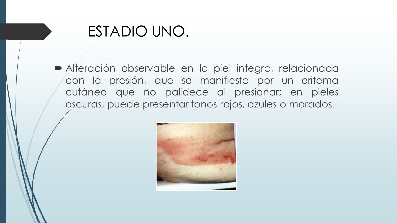 la celulitis palidece